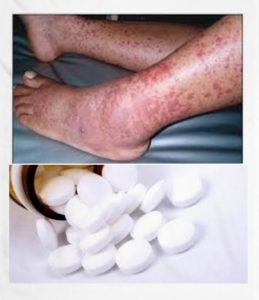 contraindicaciones del ciprofloxacino  contraindicaciones del ciprofloxacino